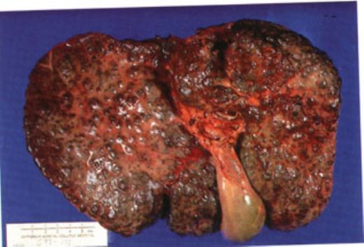 Alkolik Sirozun Nedenleri Nelerdir? 