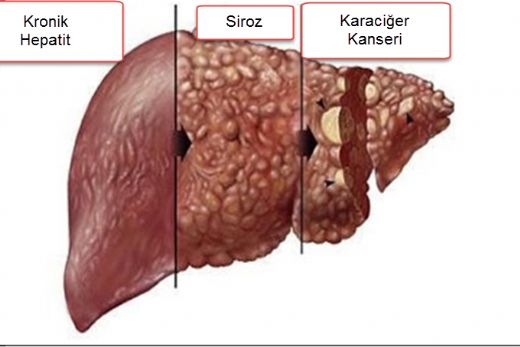 Biliyer Siroz Belirtileri ve Tedavisi