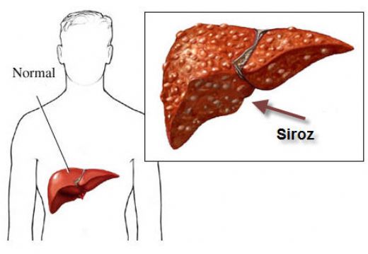 Hepatit C Siroz Belirtileri ve Tedavisi