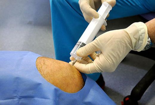 Karından Su Alınması Siroz Belirtileri ve Tedavisi