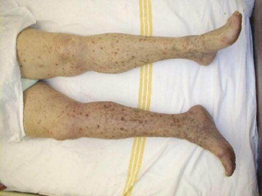 Siroz Evreleri Belirtileri ve Tedavisi