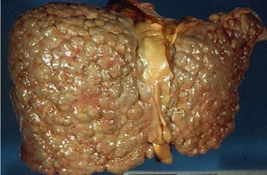 Siroz Hastalığı Son Evresi Belirtileri ve Tedavisi