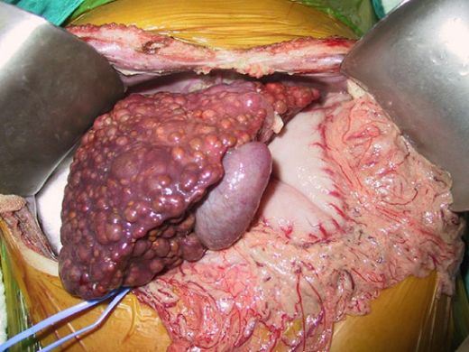 Siroz Neden Olur? Belirtileri ve Tedavisi