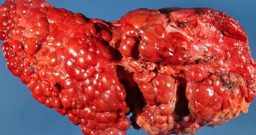 Siroz Nedir? Belirtileri ve Tedavisi