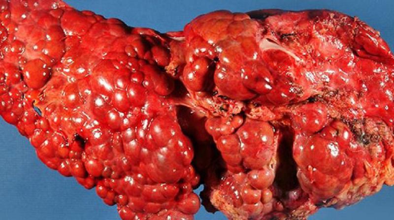 İlerlemiş Siroz Hastalığı Belirtileri ve Tedavisi