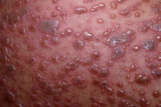 Siroz Başlangıcı Nelerdir?