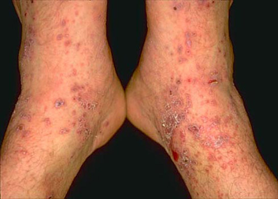 Siroz Bulaşıcı mıdır? Bulaşma Yolları